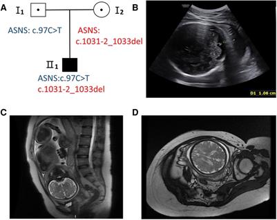 Case report: A compound heterozygous mutations in ASNS broadens the spectrum of asparagine synthetase deficiency in the prenatal diagnosis